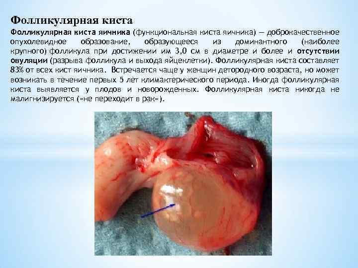 Фолликулярная киста яичника (функциональная киста яичника) — доброкачественное опухолевидное образование, образующееся из доминантного (наиболее