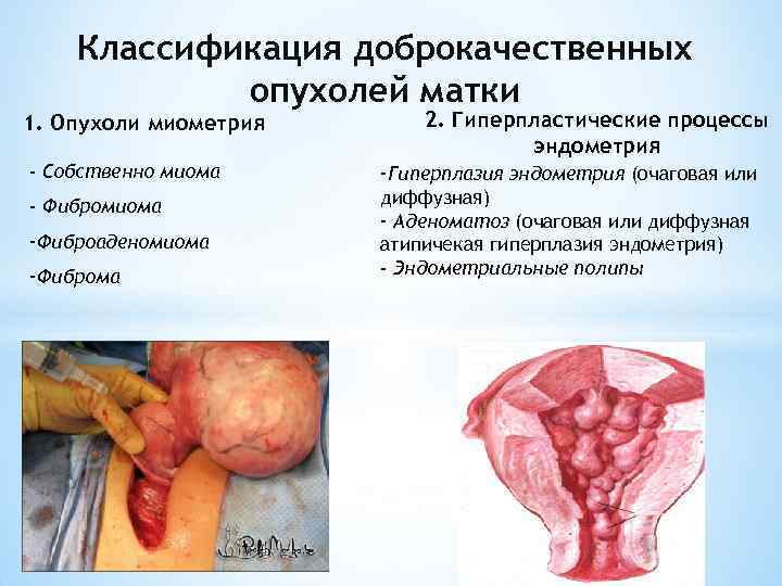 Классификация доброкачественных опухолей матки 1. Опухоли миометрия - Собственно миома - Фибромиома -Фиброаденомиома -Фиброма