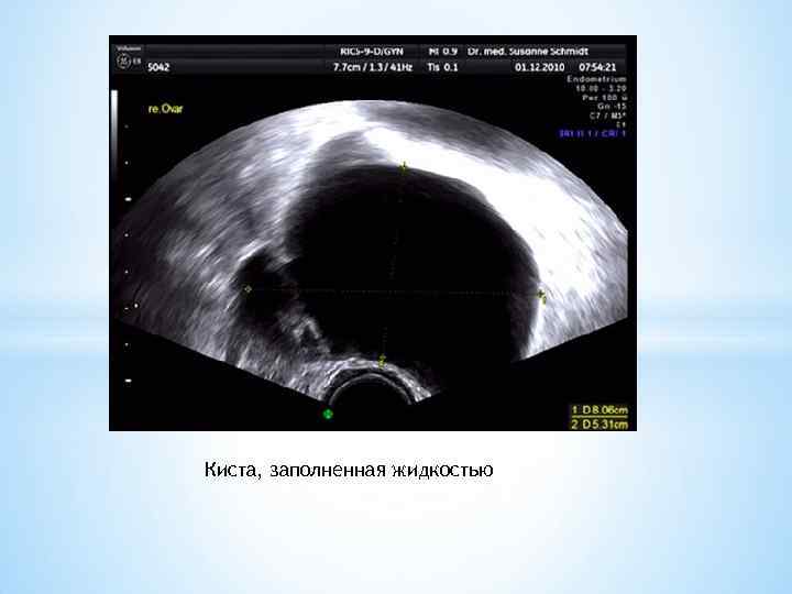 Киста, заполненная жидкостью 