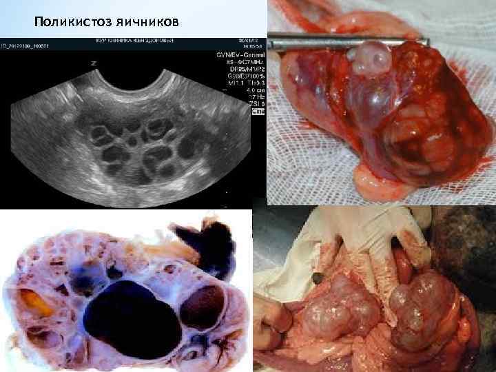 Поликистоз яичников 