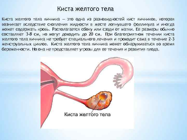 Киста желтого тела яичника — это одна из разновидностей кист яичников, которая возникает вследствие