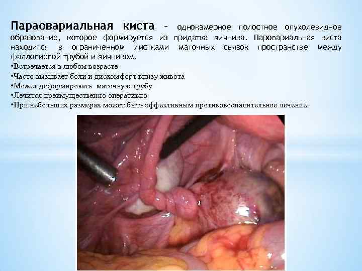 Параовариальная киста – однокамерное полостное опухолевидное образование, которое формируется из придатка яичника. Паровариальная киста