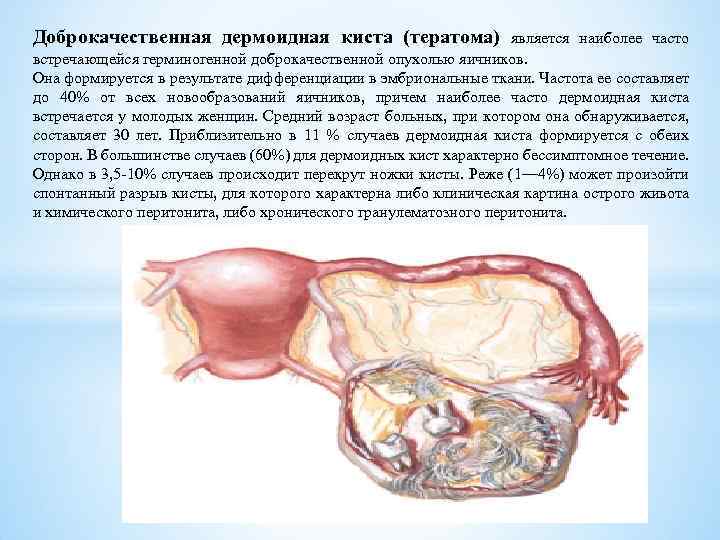 Доброкачественная дермоидная киста (тератома) является наиболее часто встречающейся герминогенной доброкачественной опухолью яичников. Она формируется