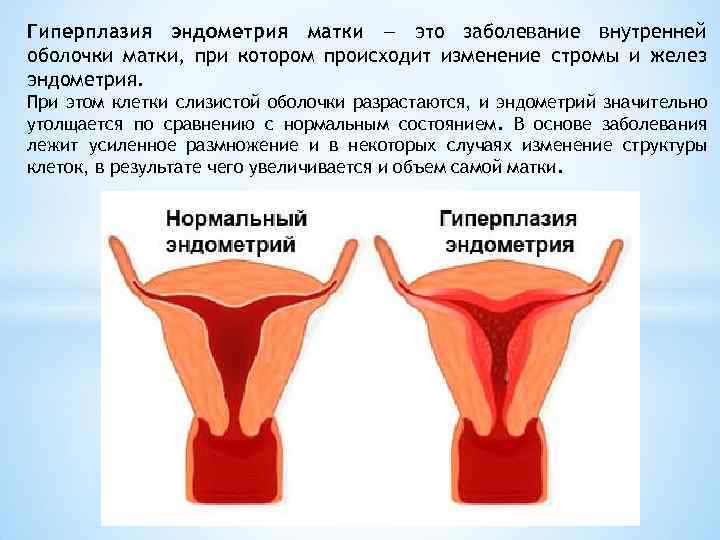 Гиперплазия эндометрия матки — это заболевание внутренней оболочки матки, при котором происходит изменение стромы