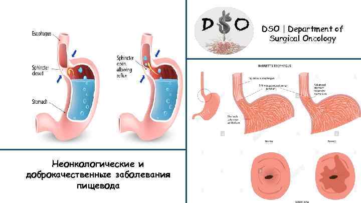 DSO | Department of Surgical Oncology Неонкологические и доброкачественные заболевания пищевода 