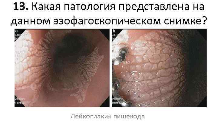 13. Какая патология представлена на данном эзофагоскопическом снимке? Лейкоплакия пищевода 
