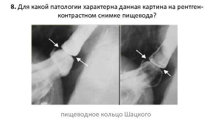 8. Для какой патологии характерна данная картина на рентгенконтрастном снимке пищевода? пищеводное кольцо Шацкого