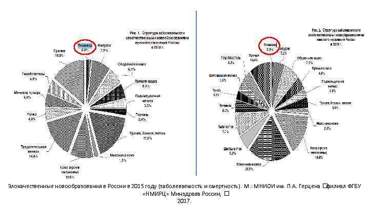 Злокачественные новообразования в России в 2015 году (заболеваемость и смертность). М. : МНИОИ им.