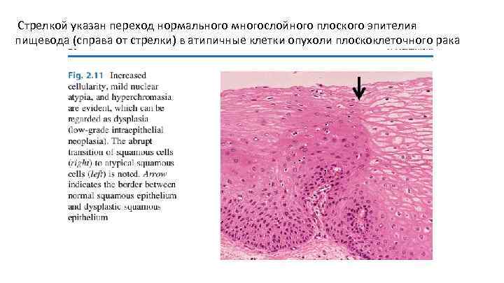  Стрелкой указан переход нормального многослойного плоского эпителия пищевода (справа от стрелки) в атипичные