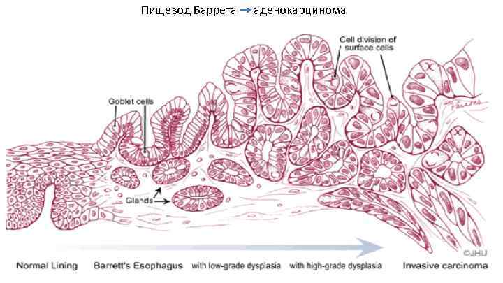 Пищевод Баррета аденокарцинома 