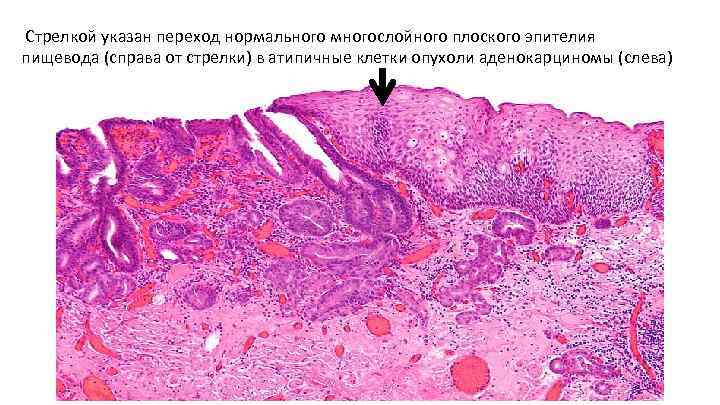  Стрелкой указан переход нормального многослойного плоского эпителия пищевода (справа от стрелки) в атипичные