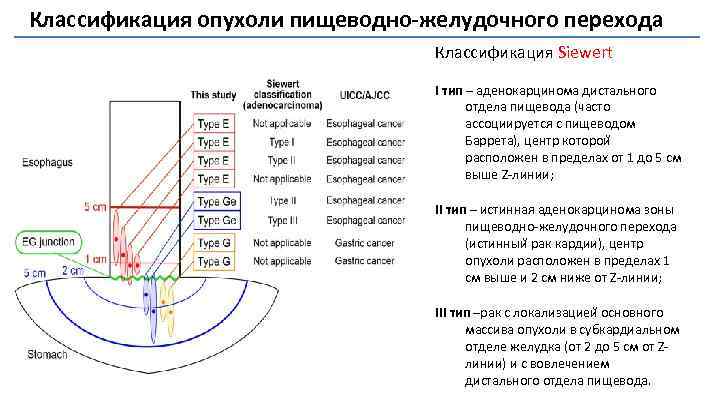 Классификация опухоли пищеводно-желудочного перехода Классификация Siewert I тип – аденокарцинома дистального отдела пищевода (часто