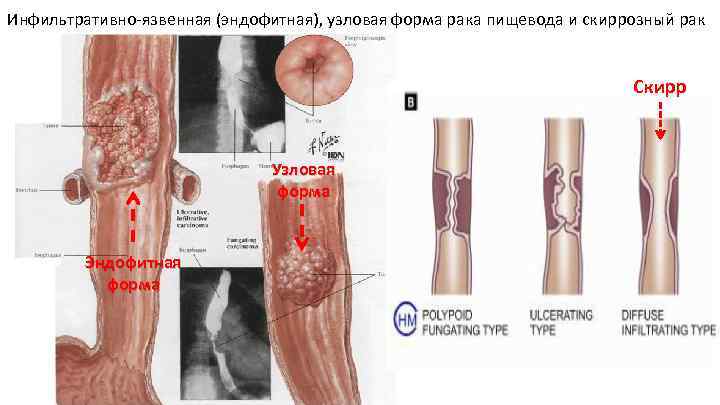 Инфильтративно язвенная (эндофитная), узловая форма рака пищевода и скиррозный рак Скирр Узловая форма Эндофитная