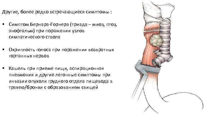 Другие, более редко встречающиеся симптомы : § Симптом Бернара Горнера (триада – миоз, птоз,