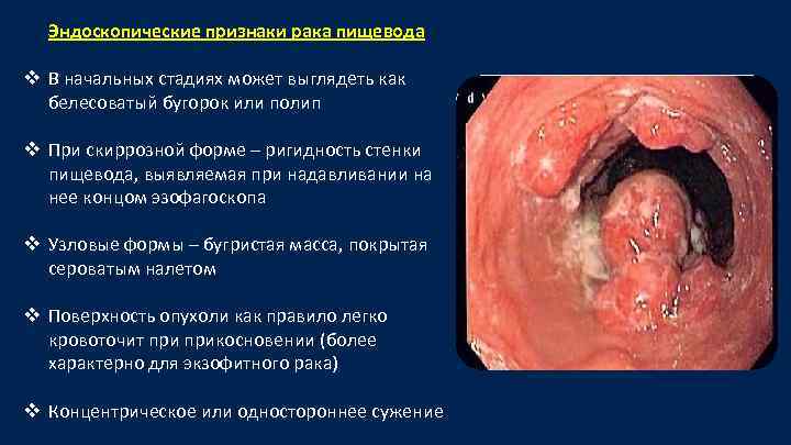 Эндоскопические признаки рака пищевода v В начальных стадиях может выглядеть как белесоватый бугорок или