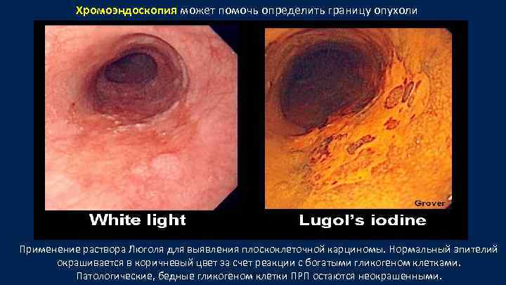 Хромоэндоскопия может помочь определить границу опухоли Хромоэндоскопия Применение раствора Люголя для выявления плоскоклеточной карциномы.