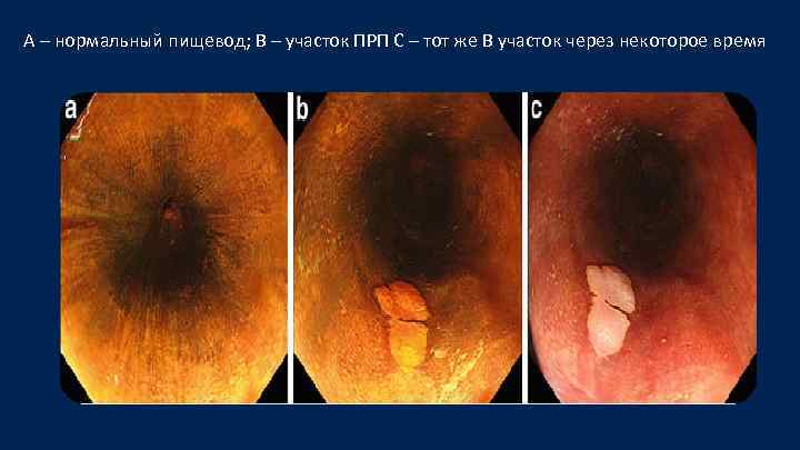 А – нормальный пищевод; B – участок ПРП C – тот же B участок