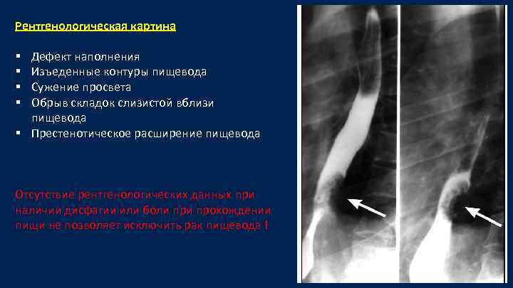 Рентгенологическая картина Дефект наполнения Изъеденные контуры пищевода Сужение просвета Обрыв складок слизистой вблизи пищевода