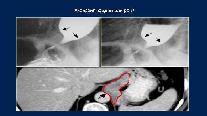 Ахалазия кардии или рак? 