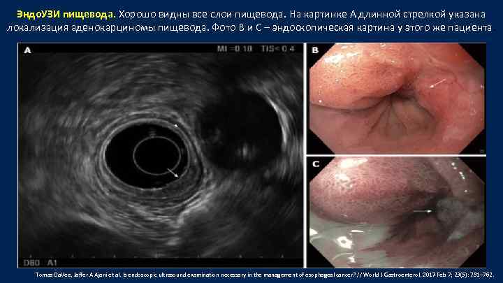 Эндо. УЗИ пищевода. Хорошо видны все слои пищевода. На картинке А длинной стрелкой указана