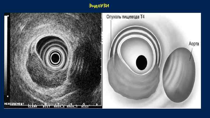 Эндо. УЗИ 
