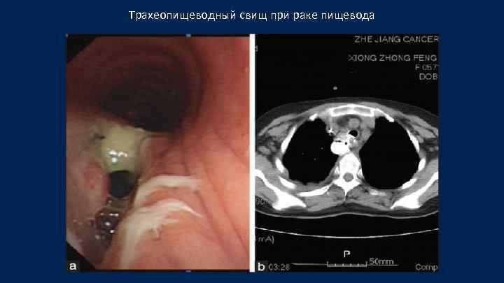 А Трахеопищеводный свищ при раке пищевода 