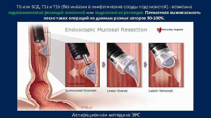 Tis или ВСД, T 1 а и T 1 b (без инвазии в лимфатические