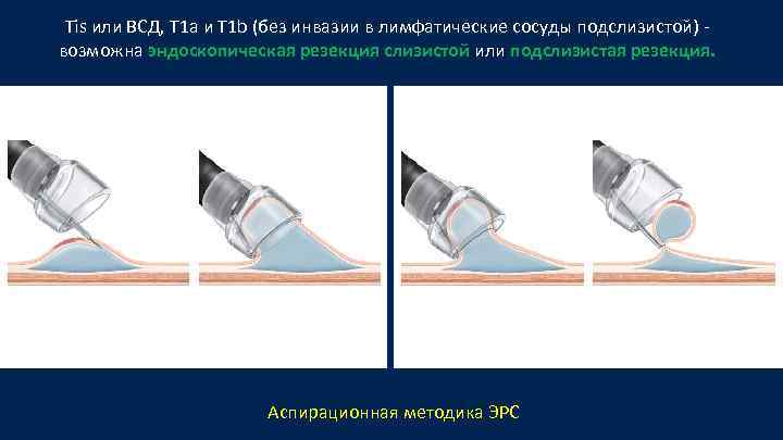 Tis или ВСД, T 1 а и T 1 b (без инвазии в лимфатические