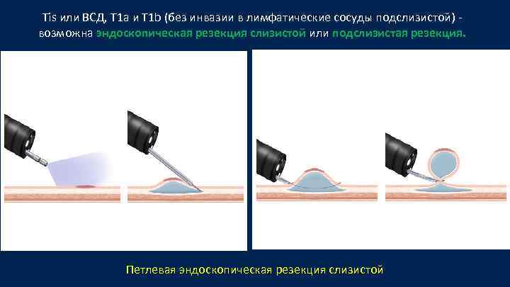 Tis или ВСД, T 1 а и T 1 b (без инвазии в лимфатические