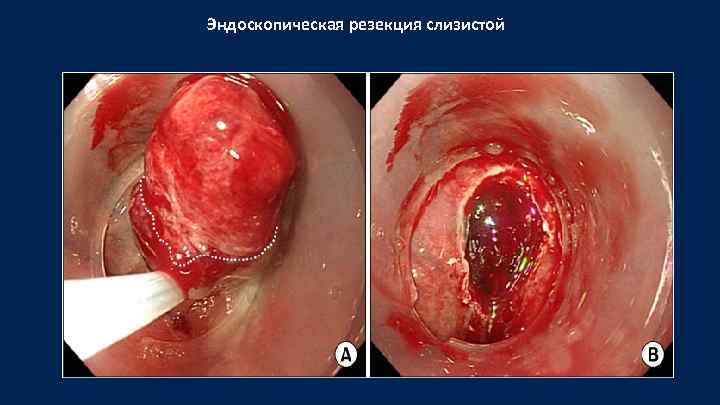 Эндоскопическая резекция слизистой 