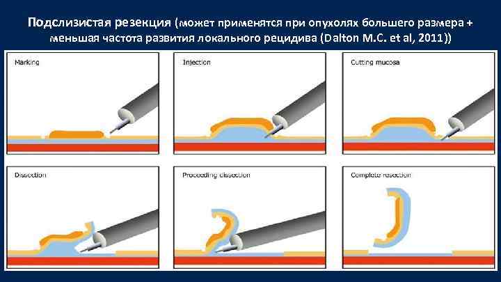 Подслизистая резекция (может применятся при опухолях большего размера + меньшая частота развития локального рецидива