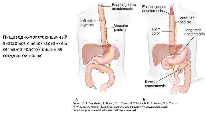Пищеводно толстокишечный анастомоз с использованием сегмента толстой кишки на сосудистой ножке 