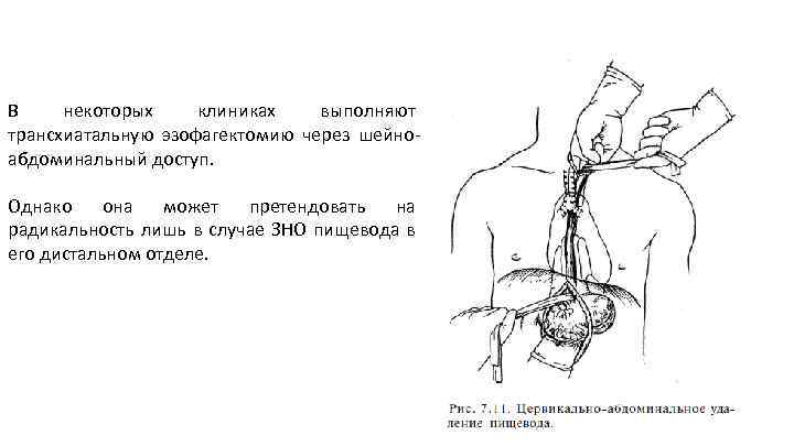 Зно пищевода карта вызова