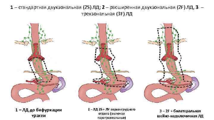 1 – стандартная двухзональная (2 S) ЛД; 2 – расширенная двухзональная (2 F) ЛД,
