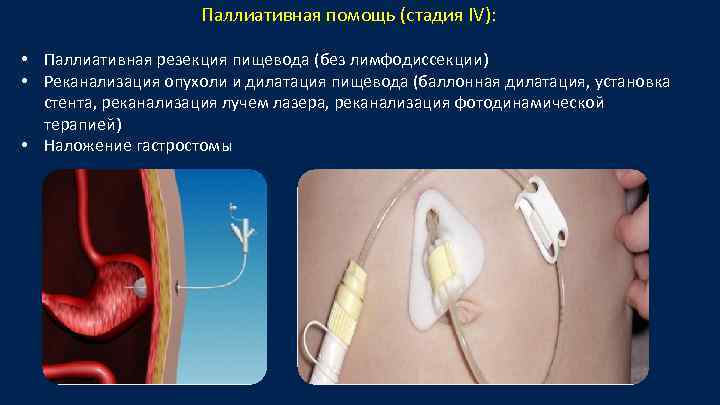 Паллиативная помощь (стадия IV): • Паллиативная резекция пищевода (без лимфодиссекции) • Реканализация опухоли и