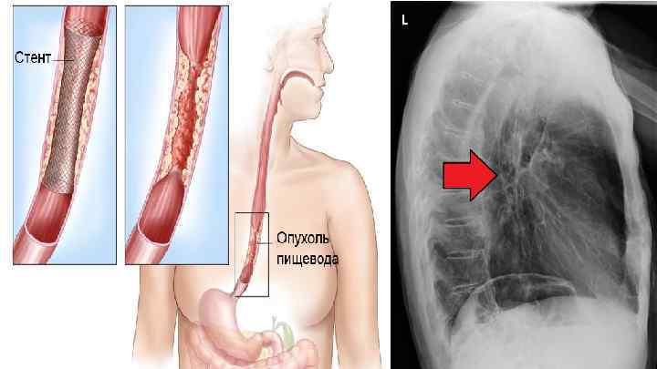 Утолщение стенок пищевода что это значит