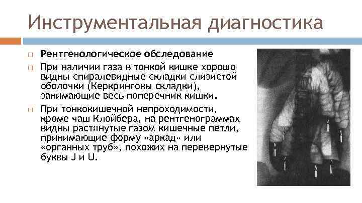 Инструментальная диагностика Рентгенологическое обследование При наличии газа в тонкой кишке хорошо видны спиралевидные складки