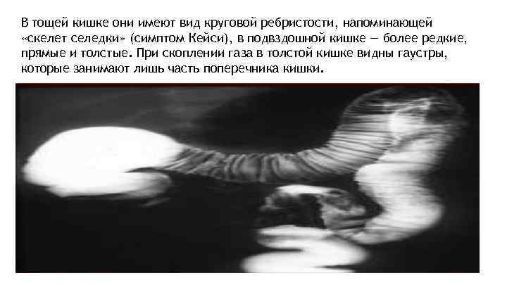 В тощей кишке они имеют вид круговой ребристости, напоминающей «скелет селедки» (симптом Кейcи), в