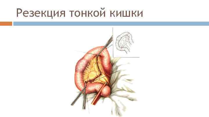 Резекция тонкой кишки 