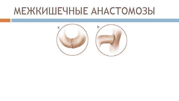 МЕЖКИШЕЧНЫЕ АНАСТОМОЗЫ 