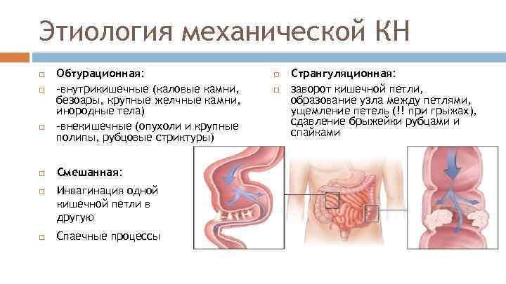 Этиология механической КН Обтурационная: -внутрикишечные (каловые камни, безоары, крупные желчные камни, инородные тела) -внекишечные