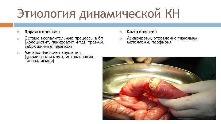 Этиология динамической КН Паралитическая: Острые воспалительные процессы в бп (холецистит, панкреатит и тд), травмы,
