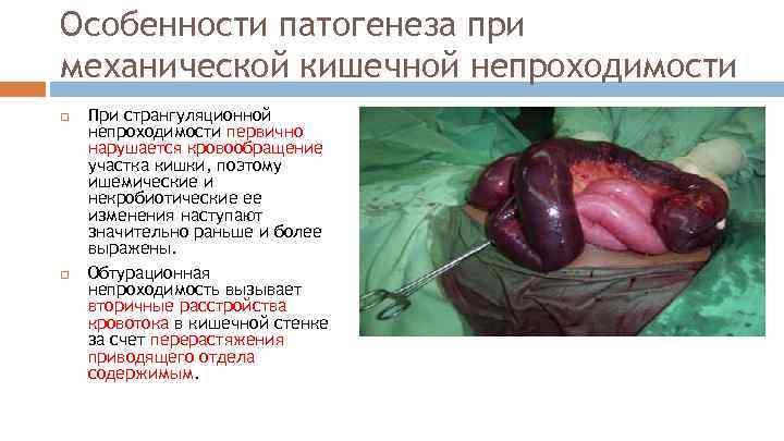 Особенности патогенеза при механической кишечной непроходимости При странгуляционной непроходимости первично нарушается кровообращение участка кишки,