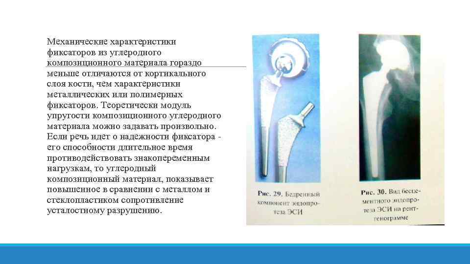 Механические характеристики фиксаторов из углеродного композиционного материала гораздо меньше отличаются от кортикального слоя кости,