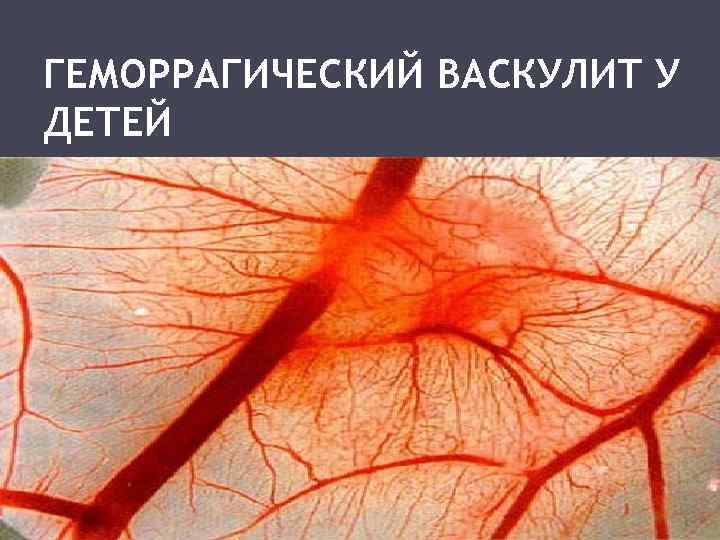 Гем васкулит у детей фото