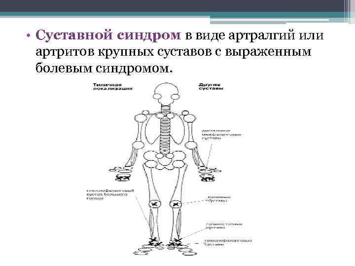 Суставной синдром у детей презентация