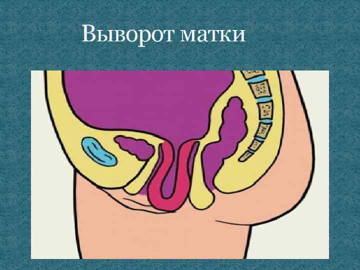 Выворот матки 