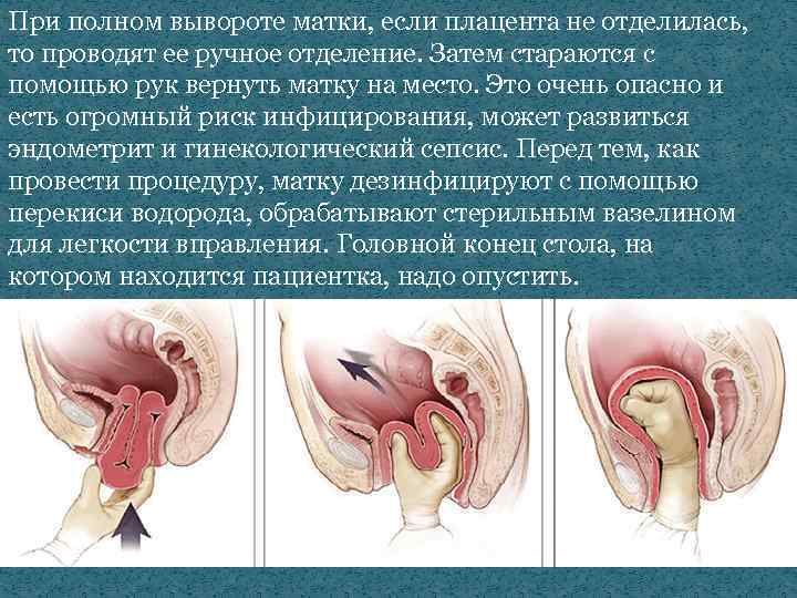 При полном вывороте матки, если плацента не отделилась, то проводят ее ручное отделение. Затем