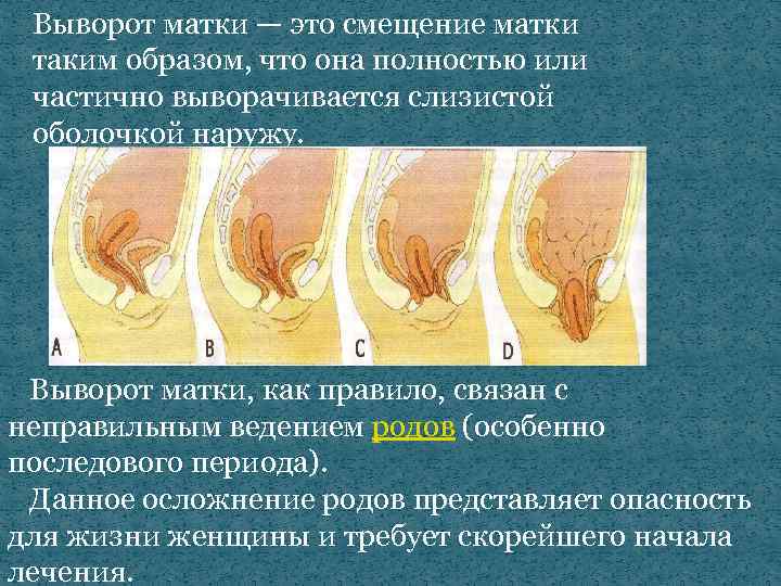 Выворот матки — это смещение матки таким образом, что она полностью или частично выворачивается