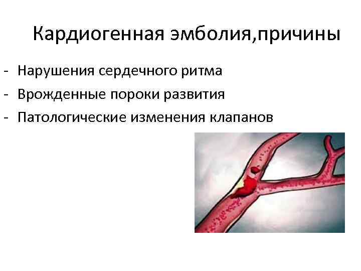 Кардиогенная эмболия, причины - Нарушения сердечного ритма - Врожденные пороки развития - Патологические изменения